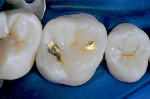 Gold Foil + Gold Inlays  Dental Gold Fillings and Inlays 